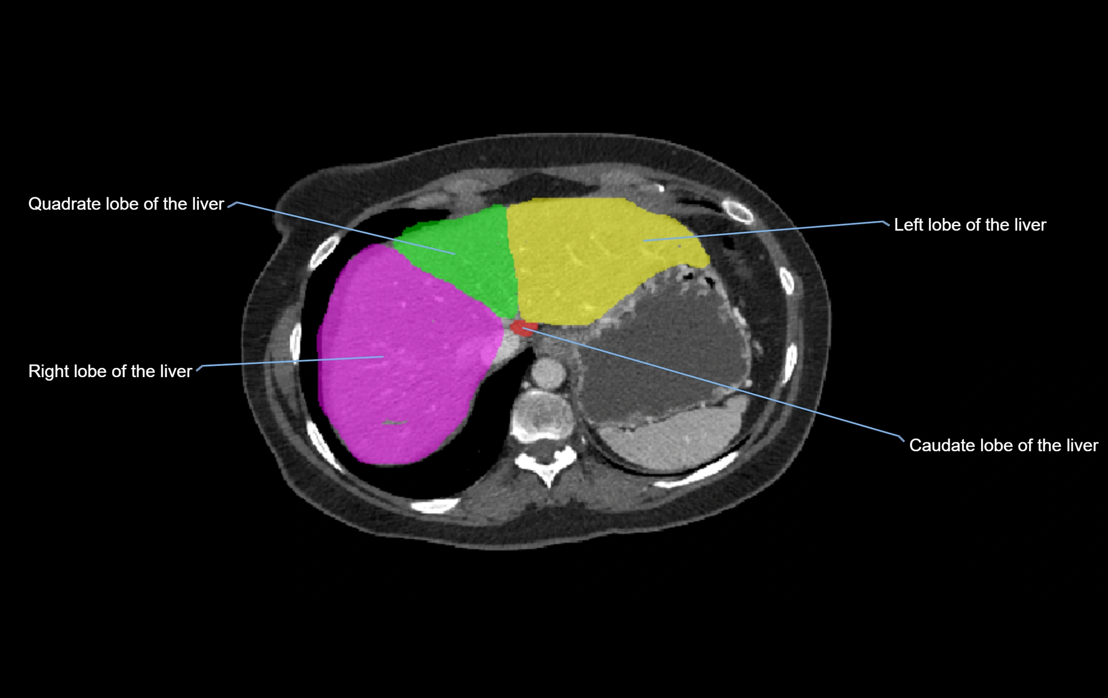 CT lliver lobes axial cross sectional anatomy labelled image -00064.webp